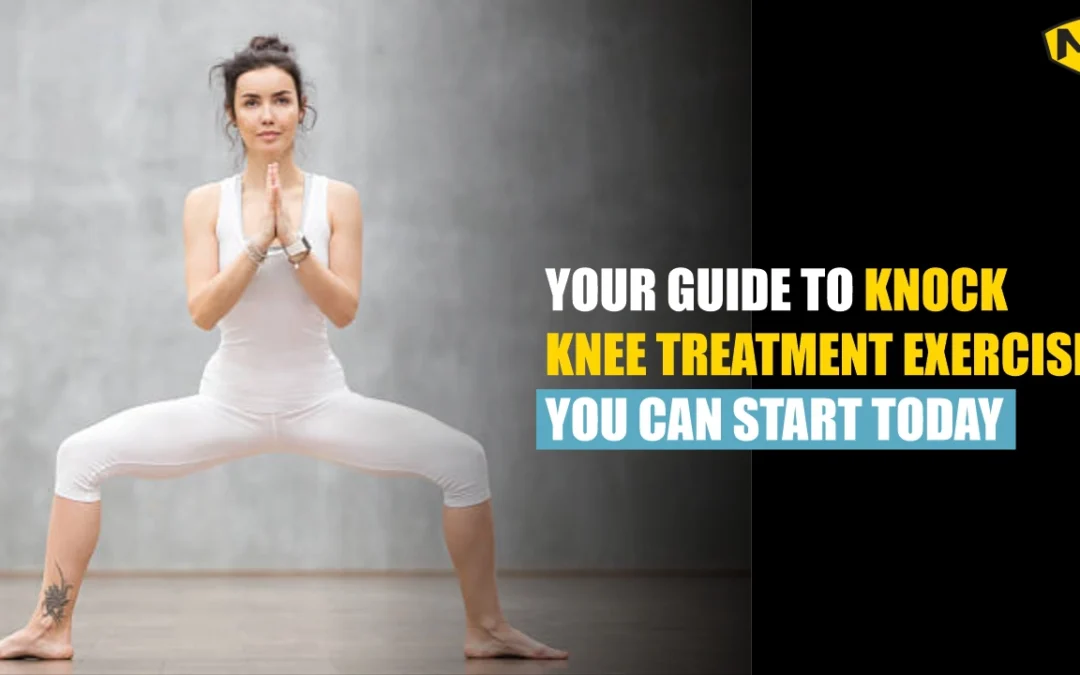 Your Guide to Knock Knee Treatment Exercise You Can Start Today