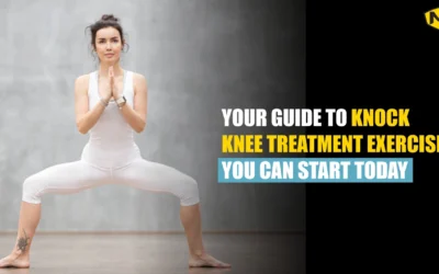 Your Guide to Knock Knee Treatment Exercise You Can Start Today